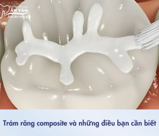 NHA KHOA BẢO TỒN - NHỮNG ĐIỀU CẦN BIẾT VỀ TRÁM RĂNG COMPOSITE