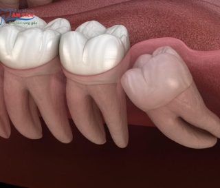 NHA KHOA BẢO TỒN - LỢI ĐANG SƯNG CÓ NHỔ RĂNG KHÔN ĐƯỢC KHÔNG?