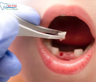 NHA KHOA BẢO TỒN - KHI NÀO NÊN NHỔ RĂNG SỮA CHO TRẺ EM