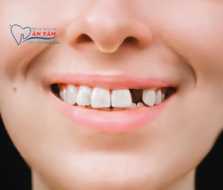 NHA KHOA BẢO TỒN - MẤT RĂNG: HẬU QUẢ VÀ CÁCH KHẮC PHỤC