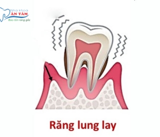 NHA KHOA BẢO TỒN - RĂNG BỊ LUNG LAY DO ĐÂU?