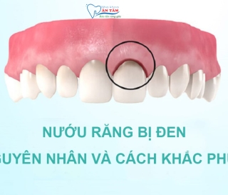 NHA KHOA BẢO TỒN - ĐIỀU TRỊ NƯỚU BỊ THÂM ĐEN