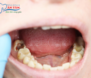 NHA KHOA BẢO TỒN - TRẺ EM BỊ SÂU RĂNG HÀM CÓ MỌC LẠI KHÔNG?