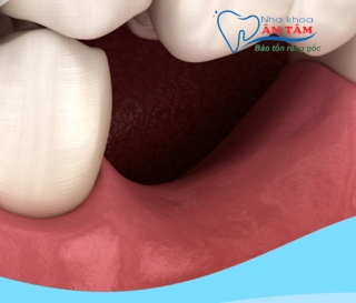 NHA KHOA BẢO TỒN - MẤT RĂNG BAO LÂU THÌ BỊ TIÊU XƯƠNG HÀM?