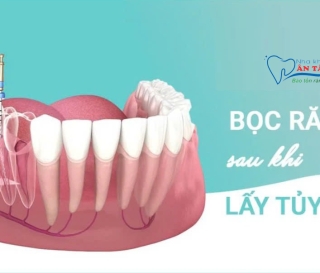NHA KHOA BẢO TỒN - CÓ NÊN BỌC RĂNG SỨ SAU KHI LẤY TỦY?