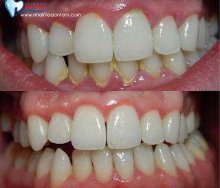 BAO LÂU NÊN CẠO VÔI RĂNG ĐỊNH KÌ 1 LẦN?