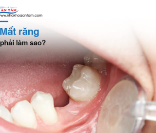 MẤT CHÂN RĂNG PHẢI LÀM NHƯ THẾ NÀO?