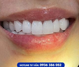 NHA KHOA BẢO TỒN - RĂNG SỨ CERCON CÓ MẤY LOẠI?