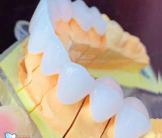 KHI NÀO THÌ NÊN BỌC RĂNG SỨ THẨM MỸ