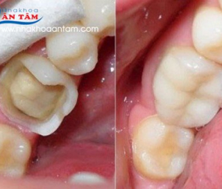 CÁCH KHẮC PHỤC RĂNG BỊ GÃY,BỂ,MẺ