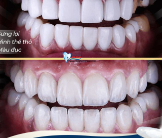 CÁCH NHẬN BIẾT RĂNG SỨ CHÍNH HÃNG VÀ RĂNG SỨ KÉM CHẤT LƯỢNG