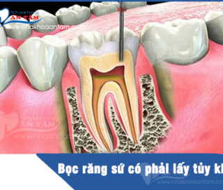 BỌC RĂNG SỨ CÓ CẦN LẤY TỦY KHÔNG?