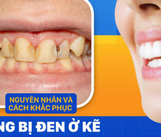 RĂNG BỊ ĐEN Ở KẼ: NGUYÊN NHÂN VÀ CÁCH KHẮC PHỤC
