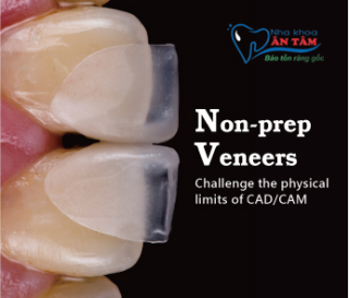 NHA KHOA BẢO TỒN - MẶT DÁN SỨ NON-PREP VENEER