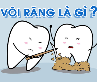 NHA KHOA BẢO TỒN - VÔI RĂNG LÀ GÌ? 