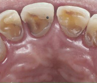 RĂNG LỘ NGÀ LÀ GÌ? ĐIỀU TRỊ TÌNH TRẠNG RĂNG BỊ LỘ NGÀ