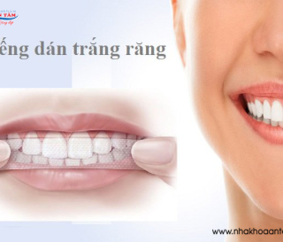 CÓ NÊN DÙNG MIẾNG DÁN TRẮNG RĂNG KHÔNG?