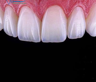 DÁN SỨ VENEER CÓ BỊ BONG RA KHÔNG?