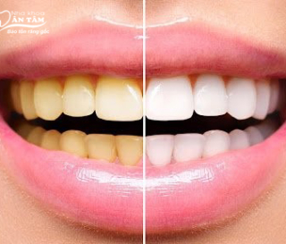 NHA KHOA BẢO TỒN - TẨY TRẮNG RĂNG CÓ BỊ VÀNG LẠI KHÔNG?
