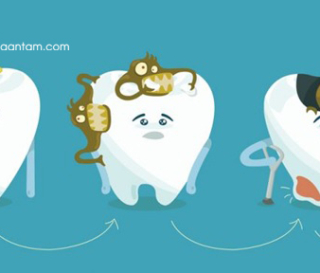 NGUYÊN NHÂN GÂY SÂU RĂNG VÀ CÁCH ĐIỀU TRỊ HIỆU QUẢ