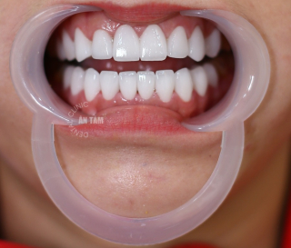VENEER EMAX – TRƯỜNG HỢP NÊN DÁN SỨ EMAX