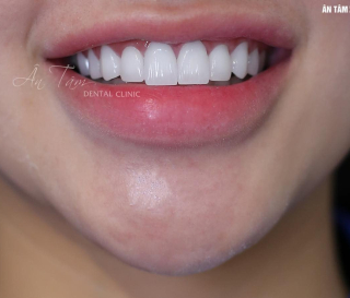 LÀM RĂNG SỨ NÊN CHỌN MÀU GÌ?