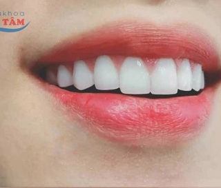 RĂNG SỨ ZIRCONIA CÓ TỐT KHÔNG?