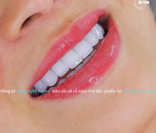 NHA KHOA BẢO TỒN - CÁCH GIỮ RĂNG SỨ LUÔN TRẮNG SÁNG
