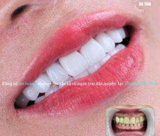 NHA KHOA BẢO TỒN - BỌC RĂNG SỨ BAO LÂU THÌ PHẢI LÀM LẠI?