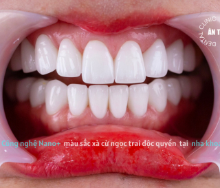 NHA KHOA BẢO TỒN - QUY TRÌNH BỌC RĂNG SỨ