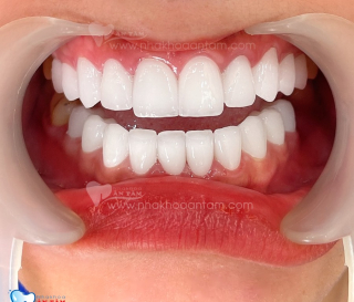 NGƯỜI TRƯỞNG THÀNH CÓ BAO NHIÊU RĂNG?ĐƯỢC PHÂN CHIA THẾ NÀO?
