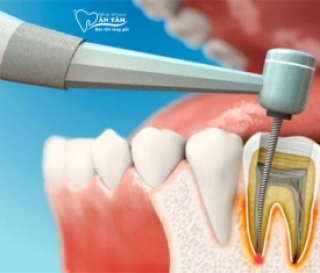  QUY TRÌNH LẤY TỦY RĂNG NHƯ THẾ NÀO? MẤT BAO LÂU?