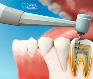NHA KHOA BẢO TỒN - QUY TRÌNH LẤY TỦY RĂNG NHƯ THẾ NÀO? MẤT BAO LÂU?