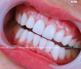 NHA KHOA BẢO TỒN - NƯỚU RĂNG LÀ GÌ: CHỨC NĂNG VÀ CÁCH CHĂM SÓC NƯỚU