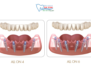 GIẢI PHÁP CHO NGƯỜI MẤT RĂNG TOÀN HÀM