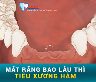 MẤT RĂNG BAO LÂU THÌ BỊ TIÊU XƯƠNG HÀM.