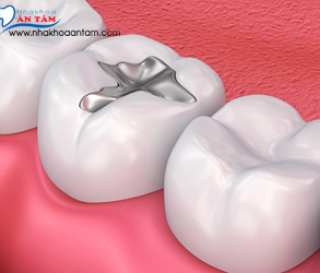 RĂNG HÀM BỊ MẺ KHẮC PHỤC NHƯ THẾ NÀO?