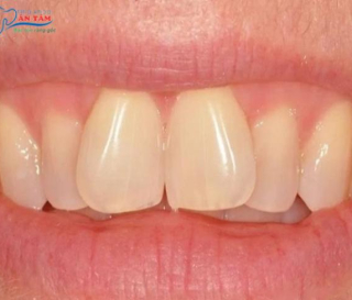 TẠI SAO NÊN CHỈNH RĂNG MỌC LỆCH?