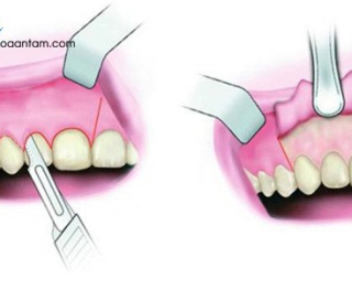 PHẪU THUẬT CẮT CHÓP RĂNG