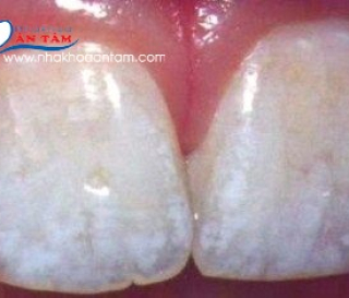 BỆNH THIỂU SẢN MEN RĂNG LÀ GÌ? NGUYÊN NHÂN DO ĐÂU VÀ CÁCH KHẮC PHỤC?