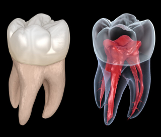 NHA KHOA BẢO TỒN - RĂNG CHẾT TỦY: NGUYÊN NHÂN VÀ CÁCH ĐIỀU TRỊ