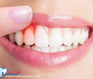 NGUYÊN NHÂN CHẢY MÁU NƯỚU RĂNG VÀ CÁCH ĐIỀU TRỊ
