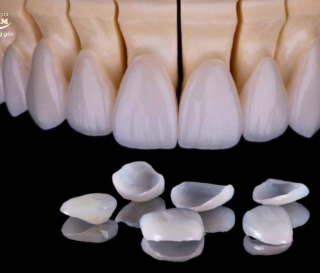 NHA KHOA BẢO TỒN - DÁN RĂNG SỨ VENEER CÓ BỀN KHÔNG?