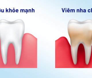 NHA KHOA BẢO TỒN: VIÊM NHA CHU – KẺ THÙ THẦM LẶNG!