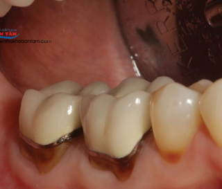 NGUYÊN NHÂN RĂNG BỌC SỨ BỊ LUNG LAY LÀ GÌ?