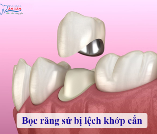 NHA KHOA BẢO TỒN - BỌC RĂNG SỨ BỊ LỆCH KHỚP CẮN: NGUYÊN NHÂN VÀ CÁCH KHẮC PHỤC