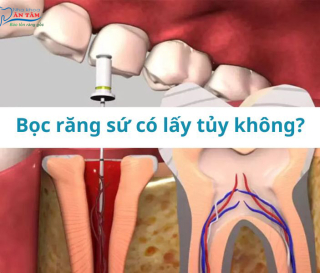 CÓ CẦN PHẢI LẤY TỦY TRƯỚC KHI BỌC SỨ KHÔNG?