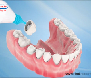 NHỮNG TRƯỜNG HỢP NÊN BỌC RĂNG SỨ HÀM DƯỚI?