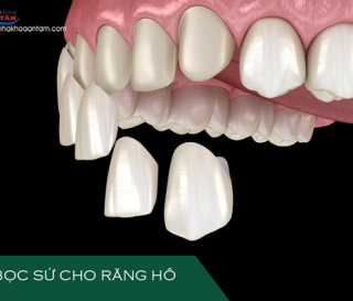 RĂNG HÔ CÓ BỌC SỨ ĐƯỢC KHÔNG?