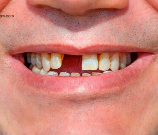 MẤT RĂNG CỬA PHẢI LÀM SAO?